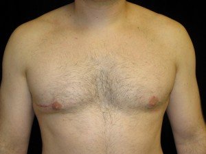 Reasons for Gynecomastia Revision Surgery