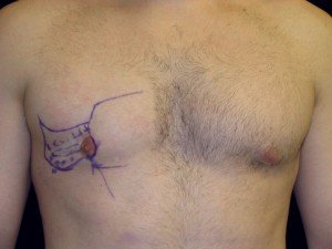 Gynecomastia Revision Surgery Reasons