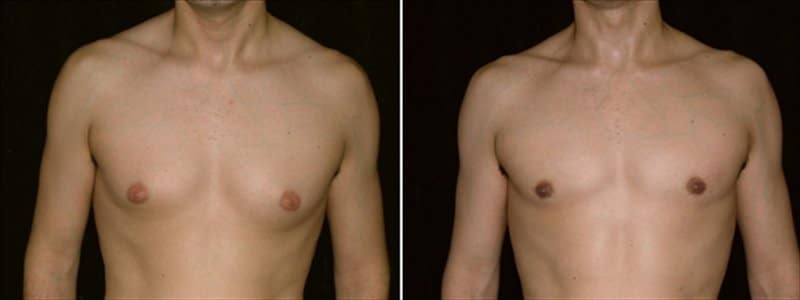 Asymmetry and Gynecomastia