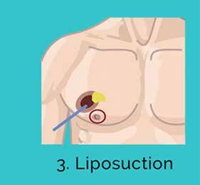 Gynecomastia Treatment liposuction phase