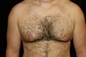 gynecomastia surgery