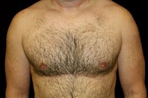 gynecomastia surgery results