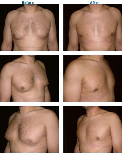 before and after of male breast reduction