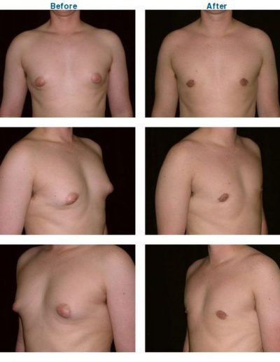 before and after of male breast reduction