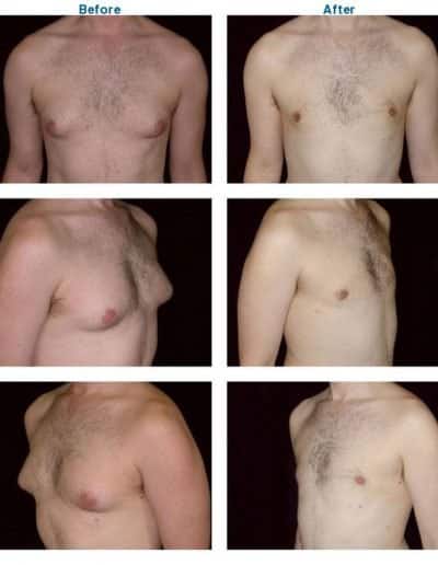 before and after of male breast reduction