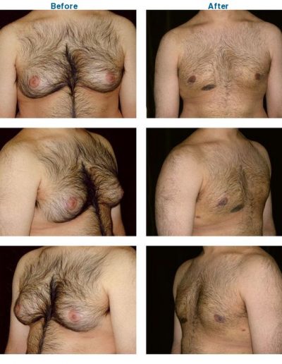 before and after of male breast reduction