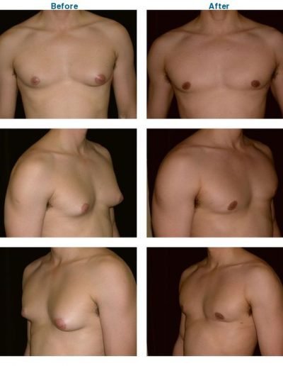 before and after of male breast reduction