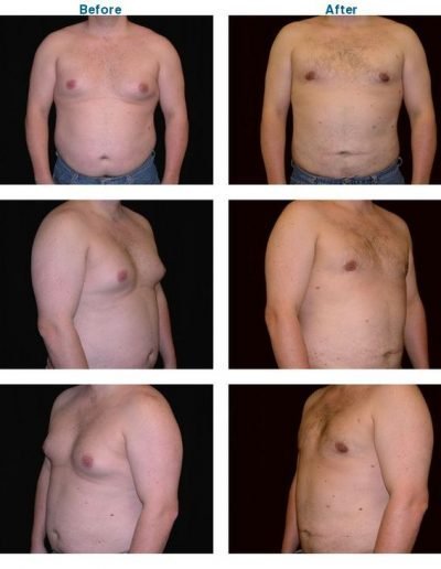 before and after of male breast reduction