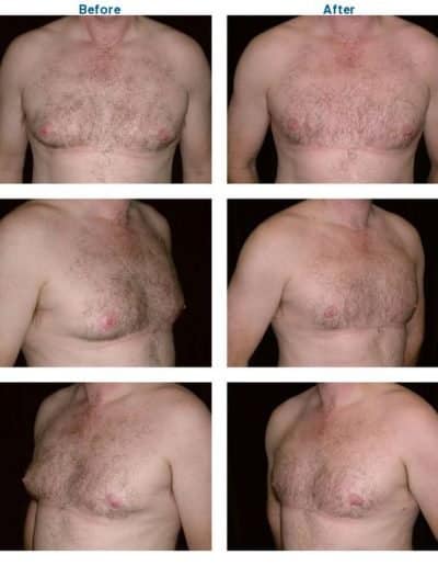 before and after of male breast reduction