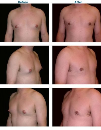 before and after of male breast reduction