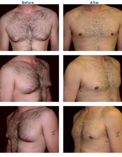 before and after of male breast reduction