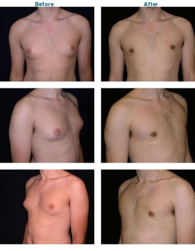 before and after of male breast reduction