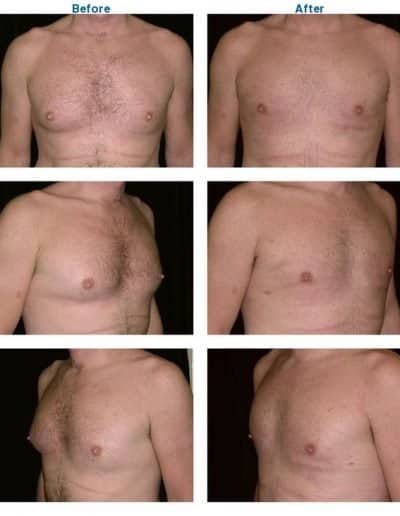 before and after of male breast reduction