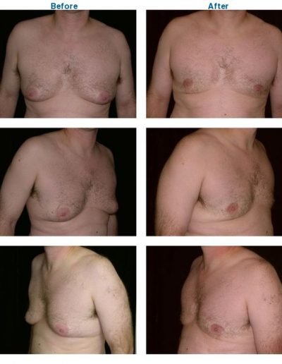 gynecomastia before and after Dr. Miguel Delgado