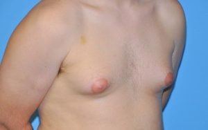 Gynecomastia Before and After