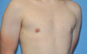 Gynecomastia Before and After