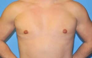 Gynecomastia Correction Before and After