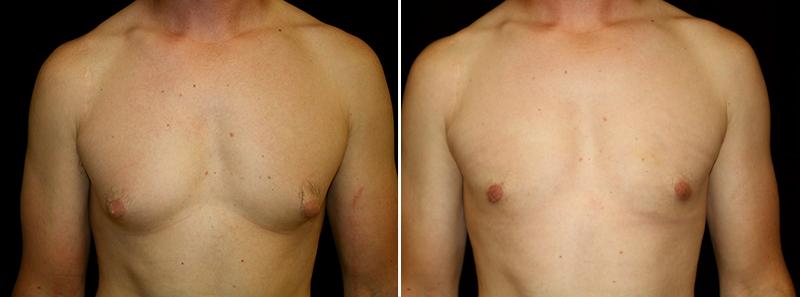 Puffy- Nipples | Gynecomastia (Male Breasts) Before And After