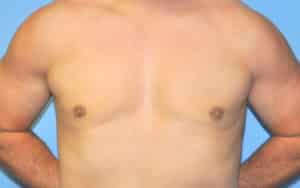 Gynecomastia Correction Before and After