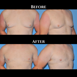 Gynecomastia Before and After