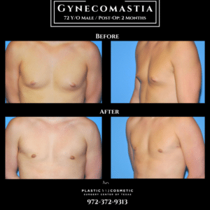 Gynecomastia Before and After Photos