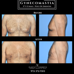 Before And After
