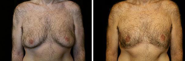 Adult gynecomastia – Before and after treatment with liposuction