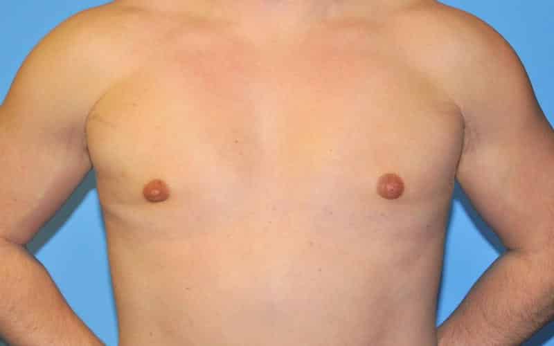 gynecomastia surgery and after