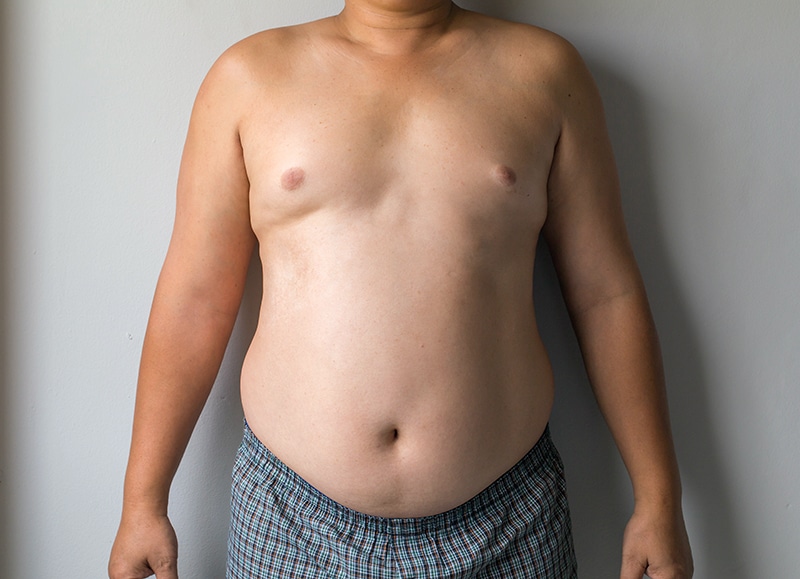 Pseudogynecomastia in Singapore