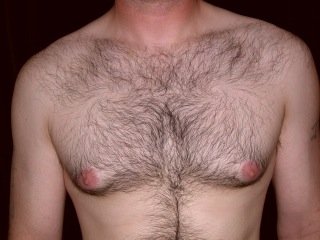 before treatment Adult Gynecomastia