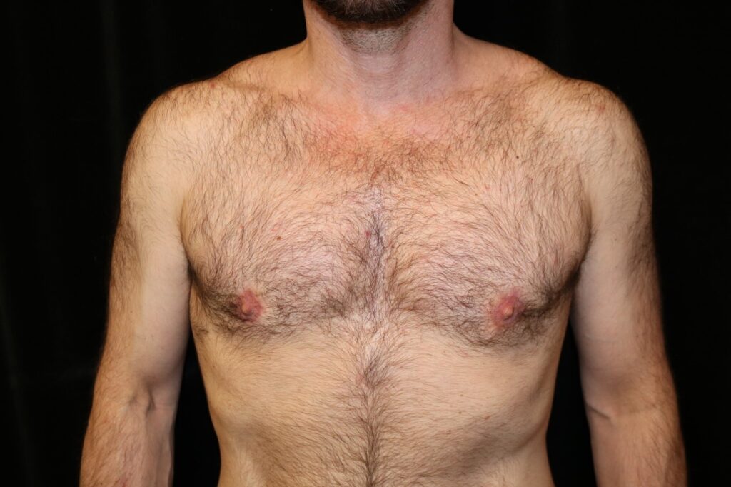 After male breast reduction surgery