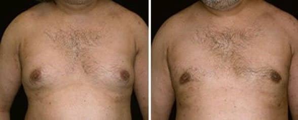 Example of Pseudogynecomastia