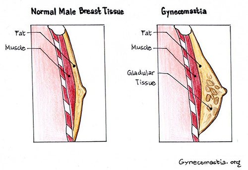 Signs and Symptoms of Adolescent Gynecomastia