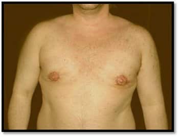 After Peri-Areolar Lift - Male Breast Reduction Surgery