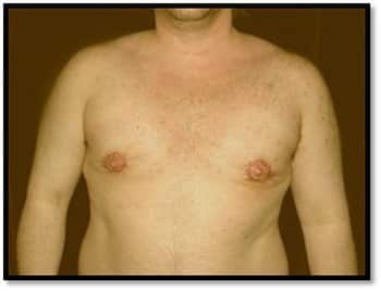 After peri-areolar lift - male breast reduction surgery