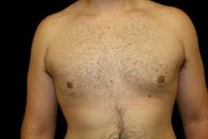 after shot of treated Gynecomastia case