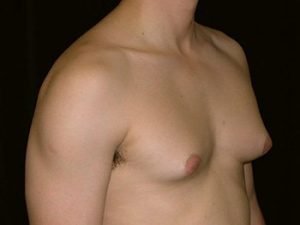 example of drug induced gynecomastia