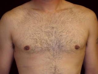 after treatment Adult Gynecomastia