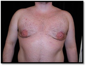 Stage 1 For Male Breast Reduction Surgery -Gland Excision With Liposuction