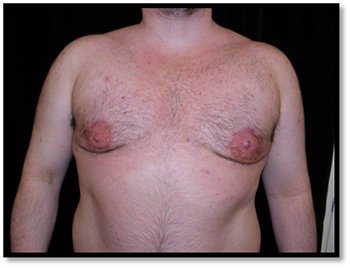 Stage 1 for male breast reduction surgery -gland excision with liposuction