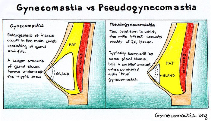gynecomsatia vs pseudogynecomastia