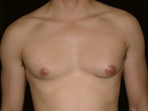 example of steroid induced gynecomastia