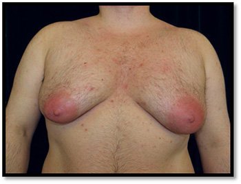 Pre-op reads for male breast reduction surgery