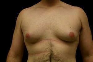 A Common Misperception of Induced Gynecomastia