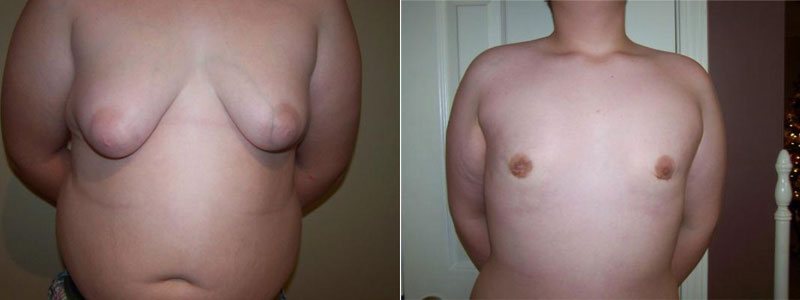 understanding teenage Gynecomastia