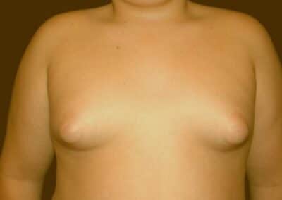 adolescent gynecomastia explained