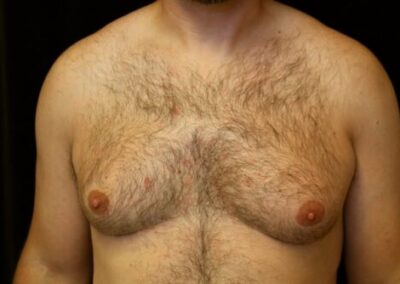 adult gynecomastia explained