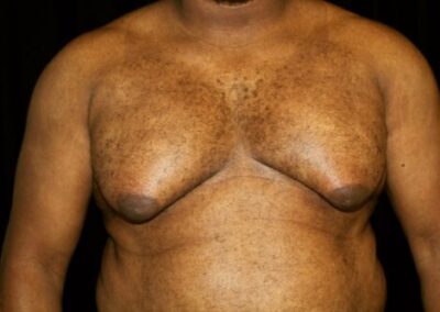 steroid induced gynecomastia explained