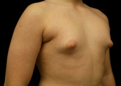 teenage gynecomastia - young man topless with puffy nipples