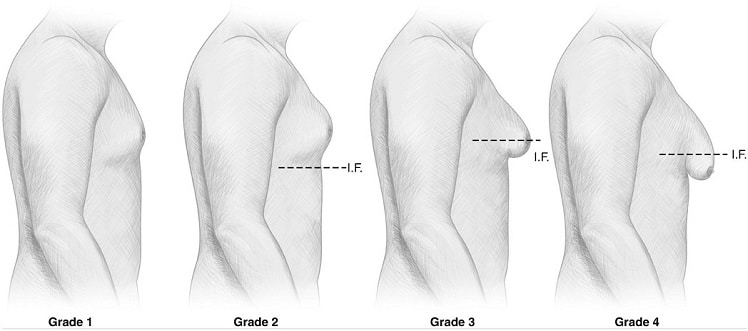 grades 1 to 4 of gynecomastia